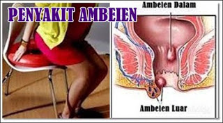 Menyembuhkan Ambeien Dengan Cepat